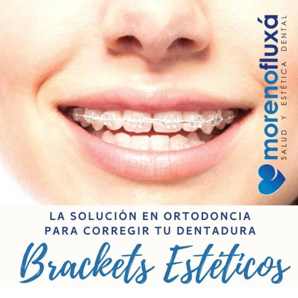 Ortodoncia estética. Tipos de brackets.